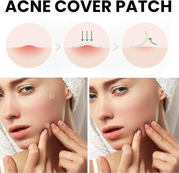 Acne Cover Patch (72pcs)