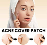 Acne Cover Patch (72pcs)